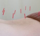 腰に鍼灸治療をうける女性